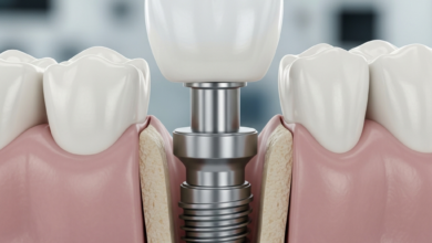 A close-up, photorealistic cross-section view of a dental implant, showing its titanium fixture firmly integrated into the jawbone, topped with an abutment and a realistic white crown. The background is a blurred medical setting.