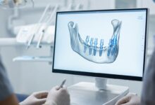 A photorealistic close-up of a computer screen in a modern dental clinic displaying a 3D digital model of a human jaw with the planned positions for a full arch of dental implants. The background is a clean, out-of-focus clinical setting.