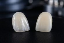 A close-up, photorealistic image showing two different types of dental veneers side-by-side for comparison. The porcelain veneer on the left is translucent and mimics natural enamel, while the composite veneer on the right is more opaque.