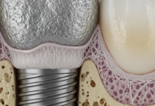 A close-up, photorealistic, microscopic view of a titanium dental implant surface partially embedded in jawbone, showing a distinct layer of soft fibrous tissue forming between the implant and the bone, signifying a failure of osseointegration. The surrounding bone shows some cellular detail.