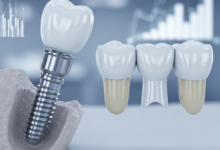 A close-up, highly detailed photorealistic image comparing a single dental implant with a titanium post, abutment, and porcelain crown, placed beside a three-unit dental bridge consisting of two crowns and a central pontic. The setting is clean, clinical, and modern, with a softly blurred background hinting at data or value comparison. No text is visible.