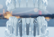 Close-up of an ultra-detailed anatomical model demonstrating the All-on-4 dental implant technique, with four metallic implants precisely placed into a jawbone. The background features a soft-focused, blurred architectural silhouette suggestive of Istanbul, Turkey.